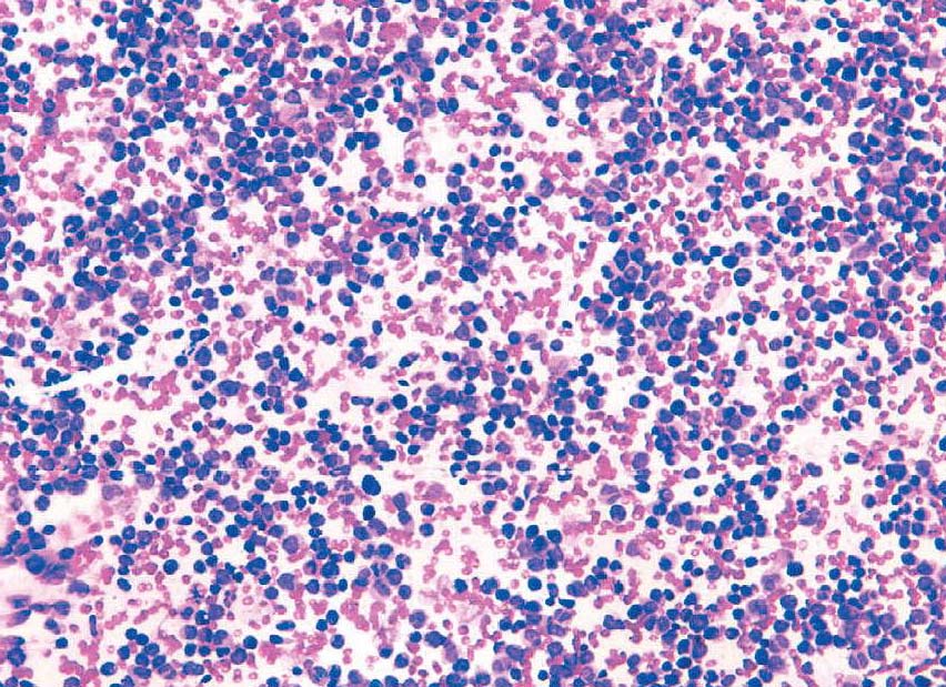 急性单核细胞白血病-M5b型